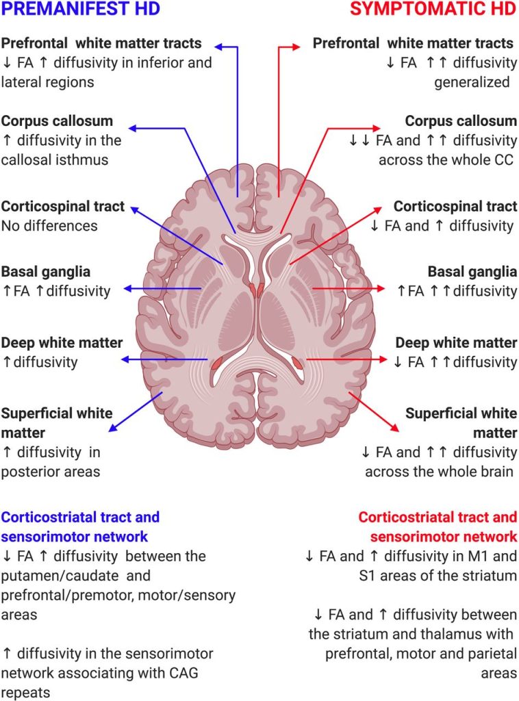 huntington s disease