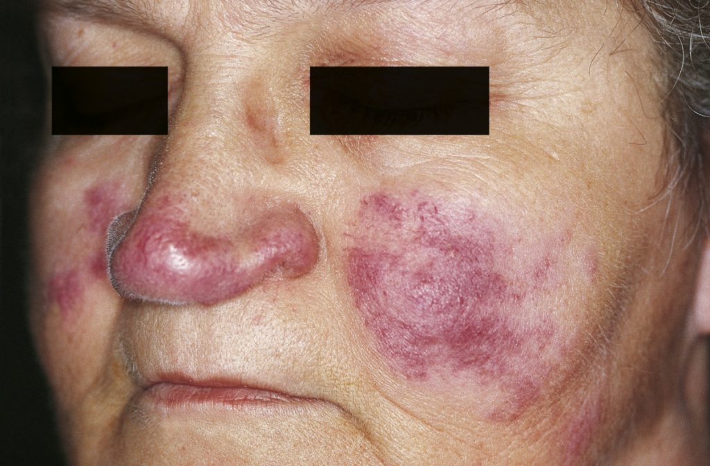 lupus